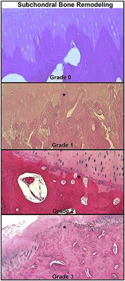 The Importance of Subchondral Bone in the Pathophysiology of Osteoarthritis